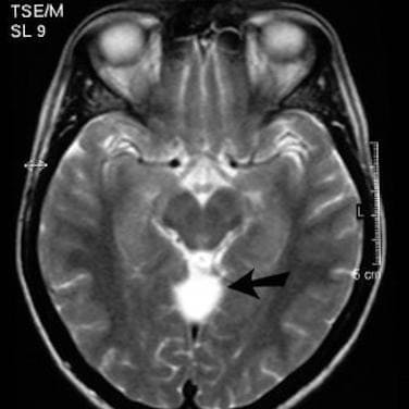киста на МРТ головного мозга на снимке